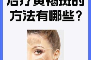 向日葵色斑卐卍 ytb 是什么？对皮肤有什么影响？如何预防和治疗？